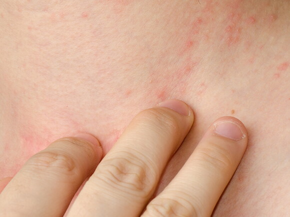 Eczema__Atopic Dermatitis